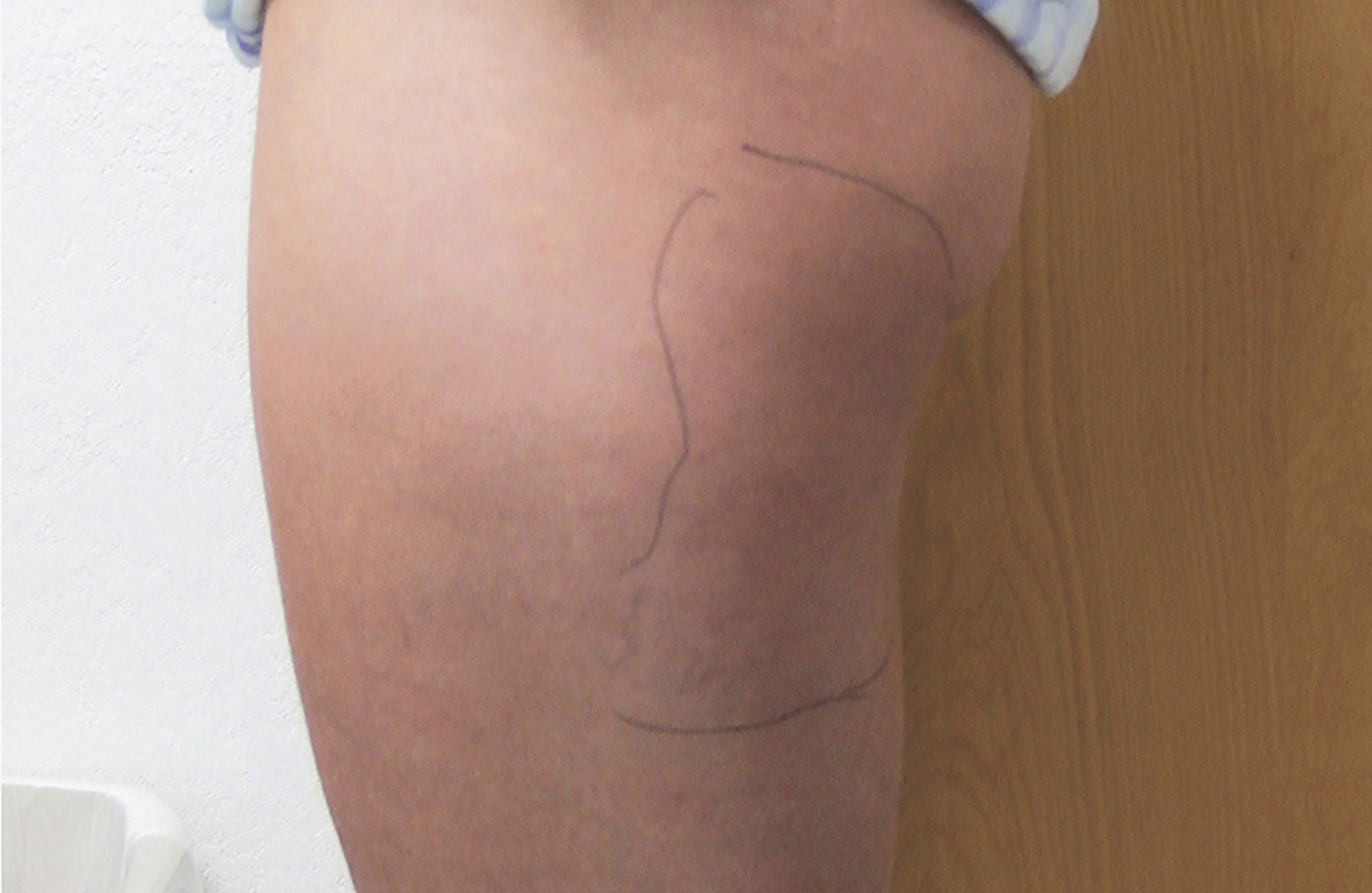BERNADETTE thigh before
