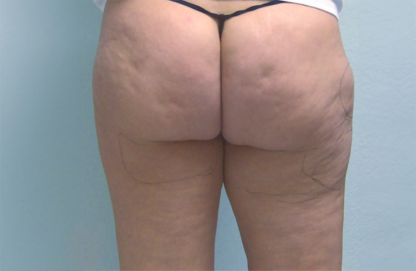 NARANJO glutes before A