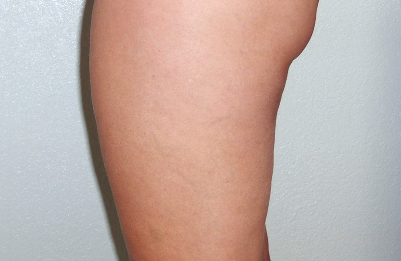 NARANJO thighs after B 72res