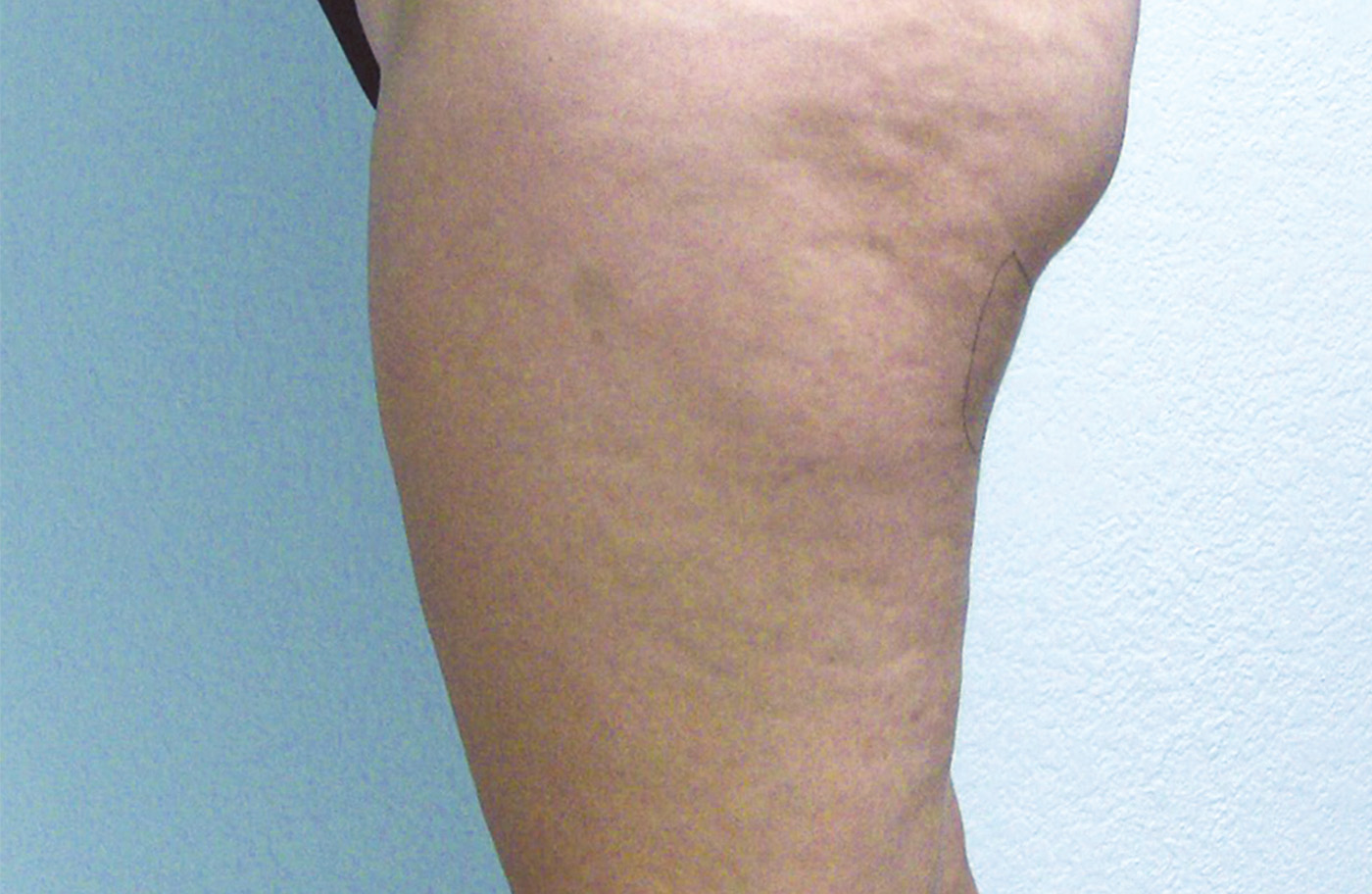 NARANJO thighs before B 72res