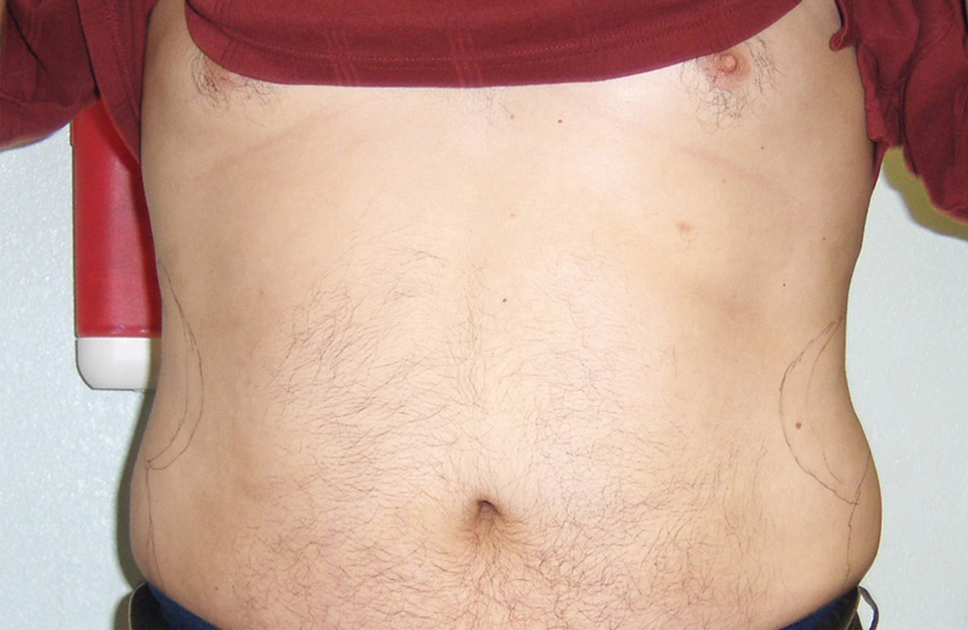 RALPH abs after 72res