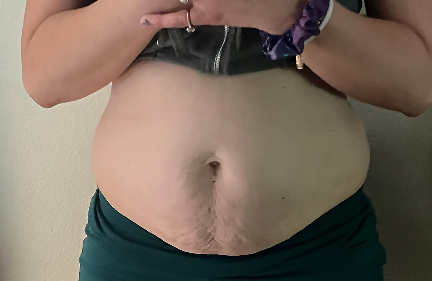 WOMAN1 stomach after 72res