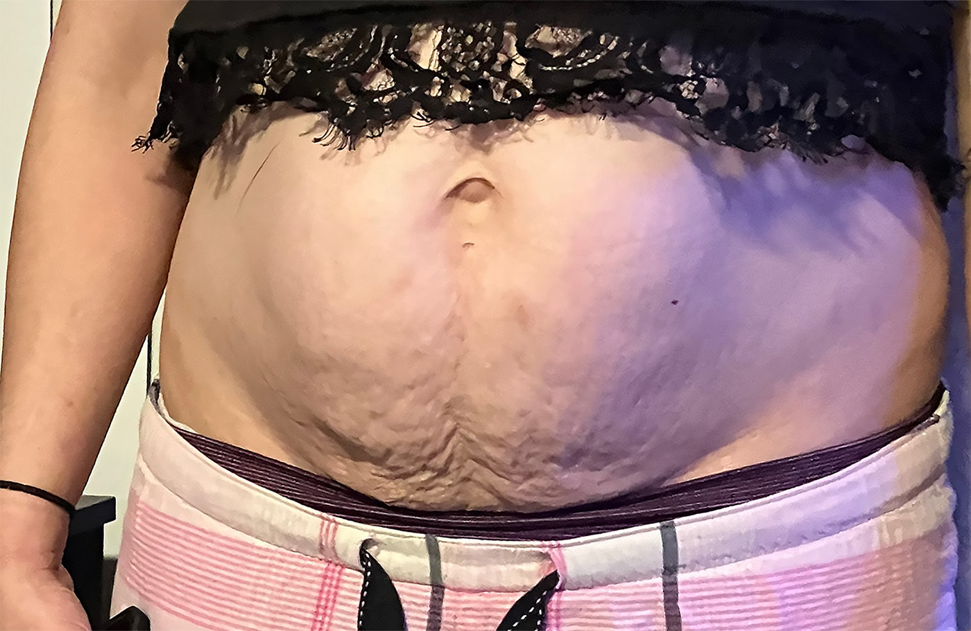WOMAN1 stomach before 72res