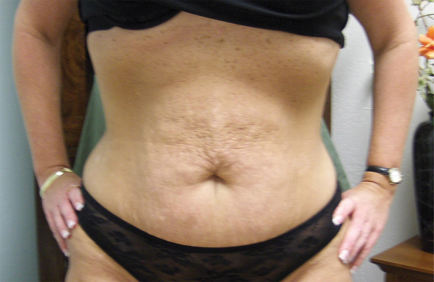 WOMAN3 waist after 72res